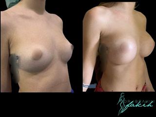 Aumento de pecho - Dr. Ibrahim Fakih
