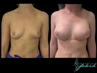 Aumento de pecho - Dr. Ibrahim Fakih