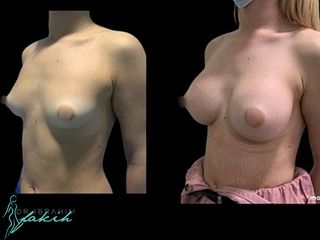 Aumento de pecho - Dr. Ibrahim Fakih