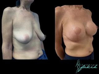 Elevación de pecho - Dr. Ibrahim Fakih