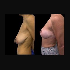 Mastopexia - Dr. Ibrahim Fakih