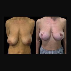 Mastopexia - Dr. Ibrahim Fakih