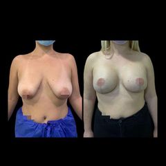 Mastopexia - Dr. Ibrahim Fakih