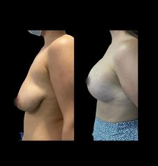 Mastopexia - Dr. Ibrahim Fakih