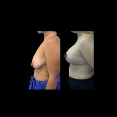 Mastopexia - Dr. Ibrahim Fakih