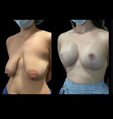 Mastopexia - Dr. Ibrahim Fakih