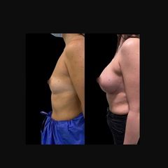 Aumento de pecho - Dr. Ibrahim Fakih