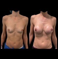Aumento de pecho - Dr. Ibrahim Fakih