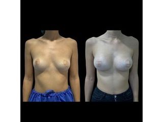 Aumento de pecho - Dr. Ibrahim Fakih