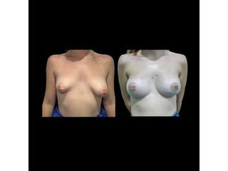 Aumento de pecho - Dr. Ibrahim Fakih