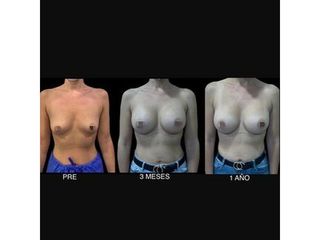Aumento de pecho - Dr. Ibrahim Fakih