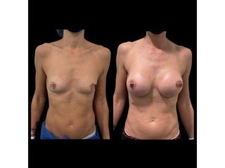 Aumento de pecho - Dr. Ibrahim Fakih