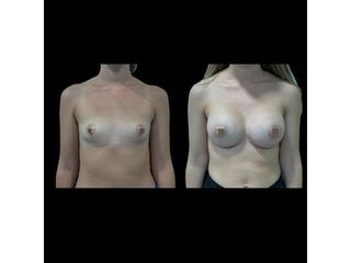 Aumento de pecho - Dr. Ibrahim Fakih