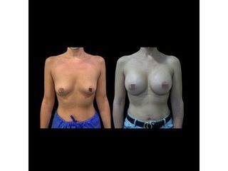 Aumento de pecho - Dr. Ibrahim Fakih