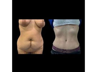 Liposucción - Dr. Ibrahim Fakih