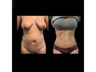 Liposucción - Dr. Ibrahim Fakih