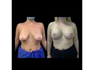 Mastopexia - Dr. Ibrahim Fakih