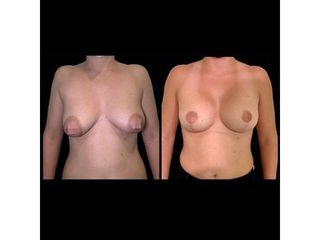 Mastopexia - Dr. Ibrahim Fakih
