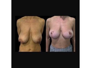 Mastopexia - Dr. Ibrahim Fakih