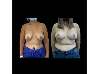 Mastopexia - Dr. Ibrahim Fakih