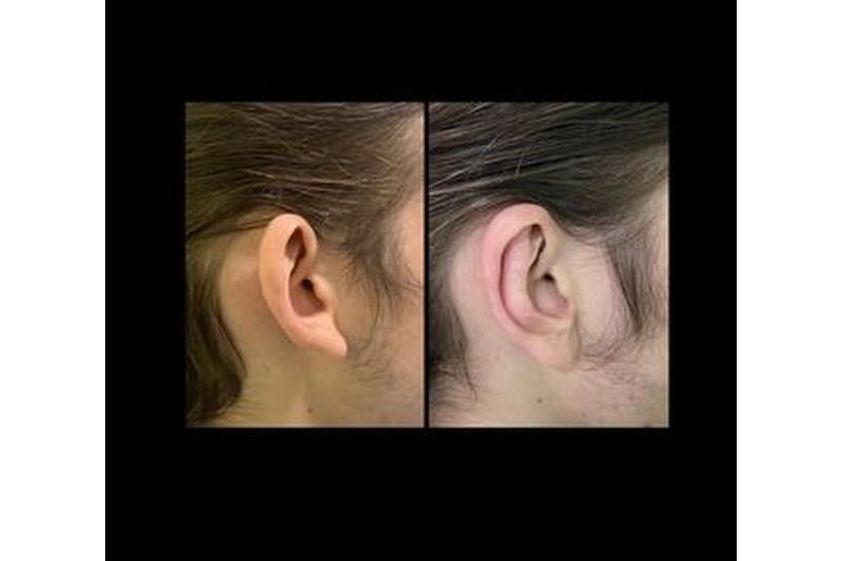 Otoplastia antes y después - 814877