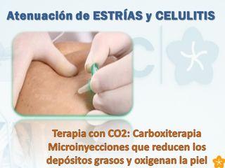 Carboxiterapia estrías, celulitis y ojeras