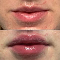 Aumento de labios - Centro Clínico Bruselas