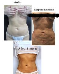 Liposucción - Centro Clínico Bruselas
