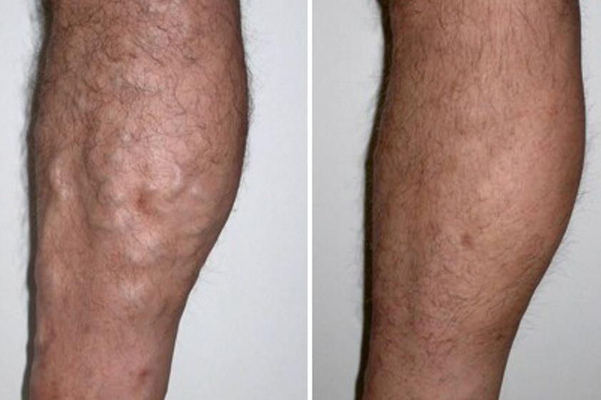 Láser vascular antes y después - 367022
