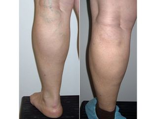 Antes y después Tratamientos vasculares