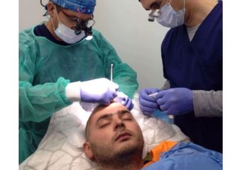 Trasplante de pelo