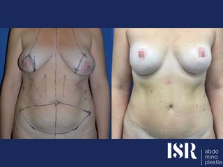 Antes y después Abdominoplastia 