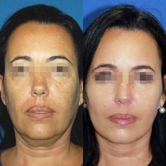 Antes y después Rejuvenecimiento facial 