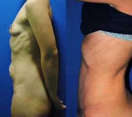 Antes y después Abdominoplastia