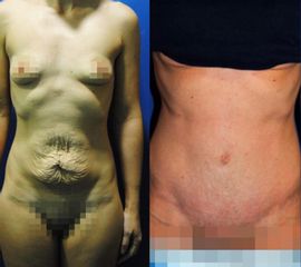 Antes y después Abdominoplastia 