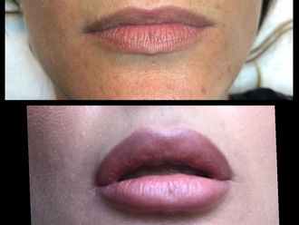 Aumento labios - 638179