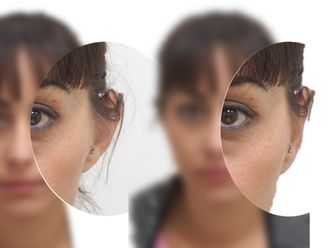 Otoplastia - 587220