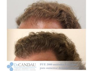 Trasplantes capilares - 637196