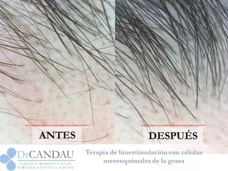 Alopecia - 637204
