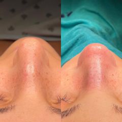 Rinoplastia - Dr. Alberto Candau