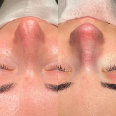 Rinoplastia - Dr. Alberto Candau