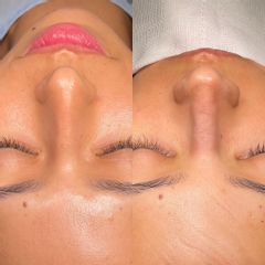 Rinoplastia - Dr. Alberto Candau
