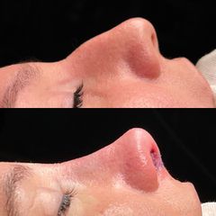 Rinoplastia - Dr. Alberto Candau