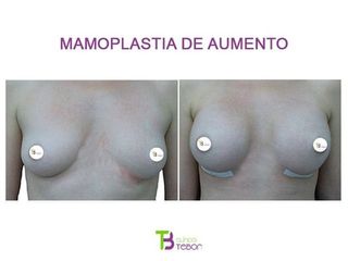 Antes y después Aumento de pecho - Clínica Tebon