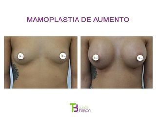Antes y después Aumento de pecho - Clínica Tebon