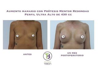 Antes y después Aumento de pecho - Clínica Tebon