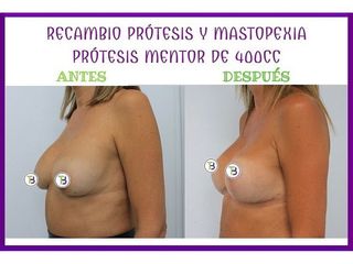 Antes y después Aumento de pecho - Clínica Tebon