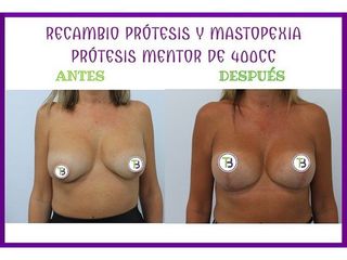 Antes y después Mastopexia - Clínica Tebon