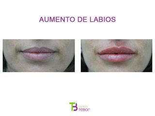 Aumento de labios - Clínica Tebon