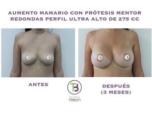 Aumento de pecho - Clínica Tebon